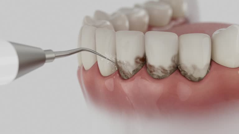 Trusted Wisdom Tooth Removal service in Mount Dora, FL - Dentist Open Now